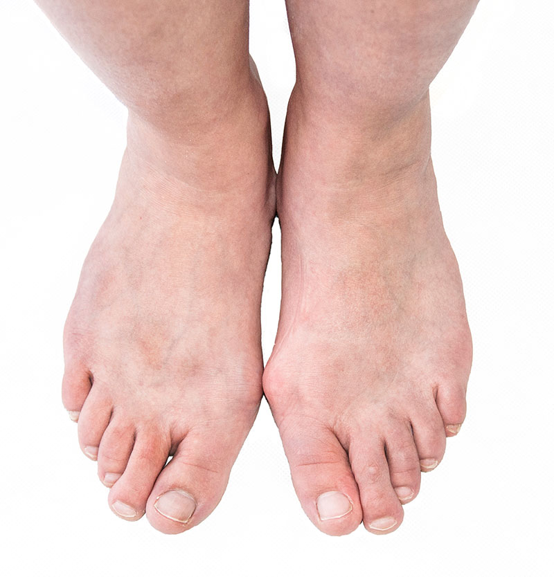 Profilaktyka stopy reumatoidalnej